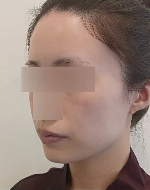 지방이식부작용, 왜 생기고 어떻게 관리할까?