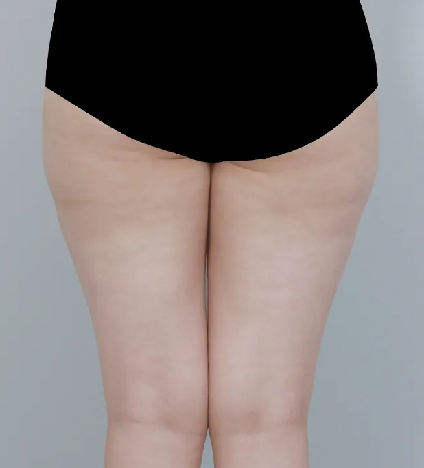 허벅지 안쪽 지방흡입 가격 비교 전 꼭 알아야 할 포인트