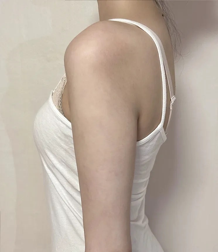 팔 지방흡입 통증 줄이는 방법, 회복기 관리가 핵심입니다!
