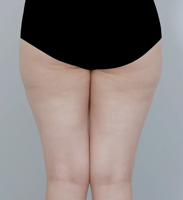 허벅지 안쪽 지방흡입 가격 왜 다 다를까?