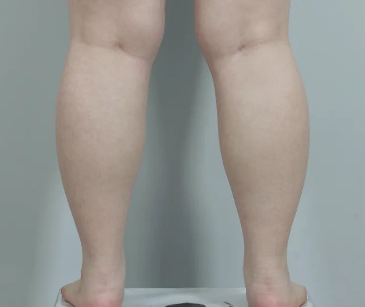 허벅지종아리지방흡입 높은 만족을 위한 핵심