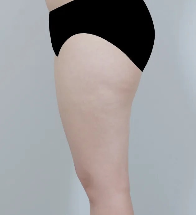 허벅지 지방흡입 cc가 중요한 게 아니다? <의사 의견>