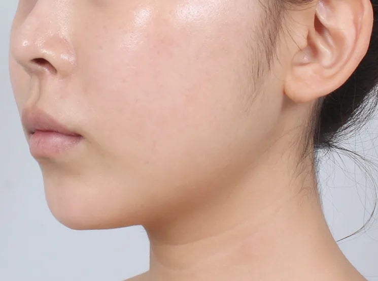 심부볼 지방흡입으로 인상까지 달라진다?