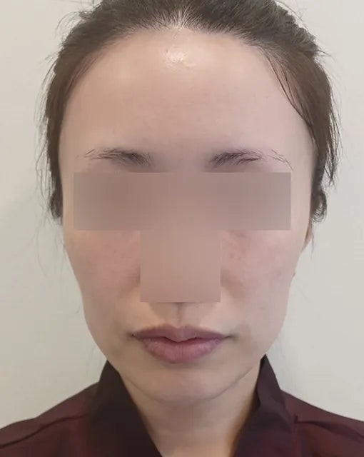 얼굴지방이식붓기 생각보다 심하지 않은 이유