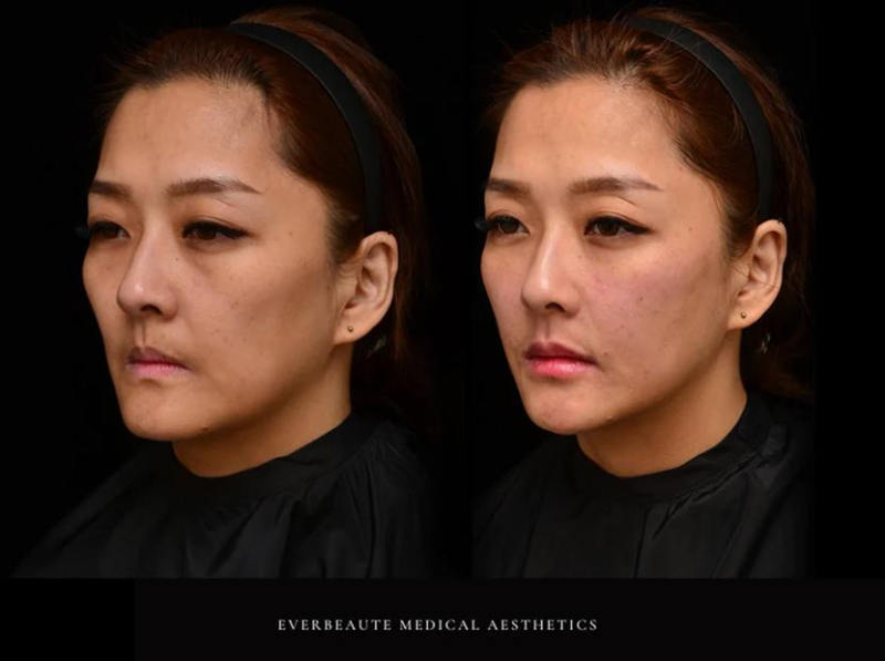 대구옆볼필러, 옆광대가 큰데 채우면 얼굴이 더 넓어질까요?