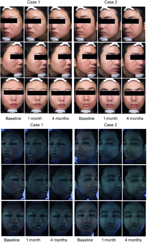 보톡스필러차이 상황별 정리<의사작성>