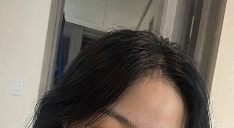 청주이마필러 비대칭 없으려면?