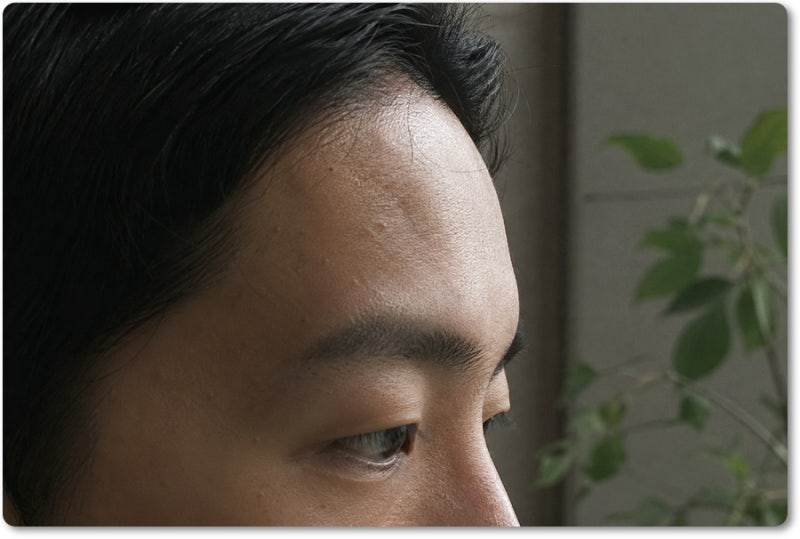 청주이마필러 과해 보이지 않으려면 보는 순서