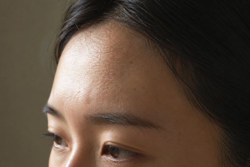 이마필러 부작용 울퉁불퉁 엠보 원인 및 신호는?