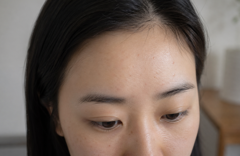 이마필러 부작용 울퉁불퉁 엠보 원인 및 신호는?