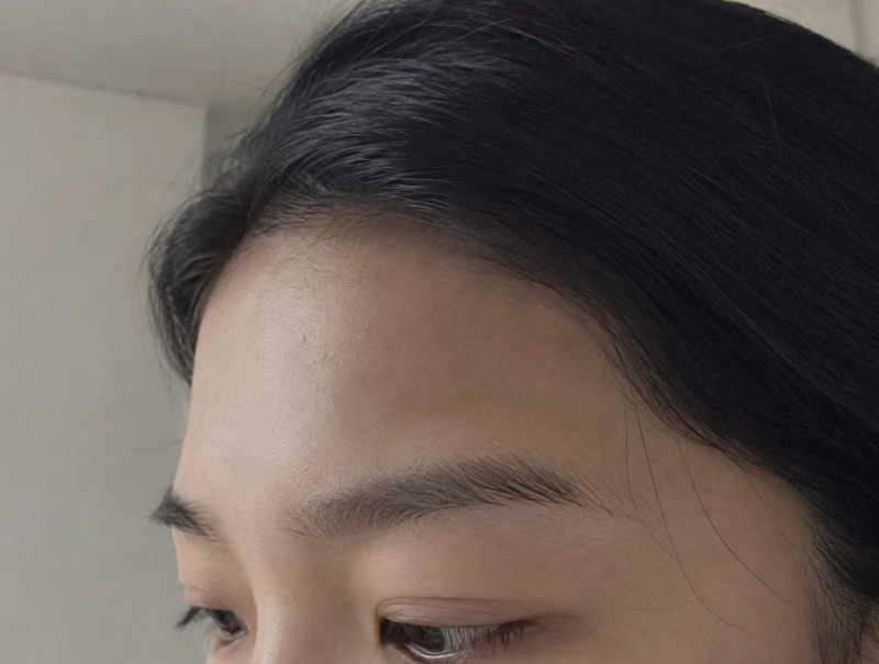 청주이마필러 앞머리 넘겼을 때 어색한 이유