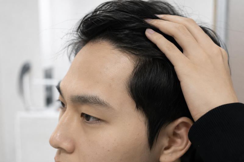 청주이마필러 앞머리 넘겼을 때 어색한 이유