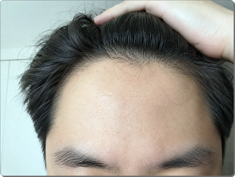 청주이마필러 앞머리 넘겼을 때 어색한 이유