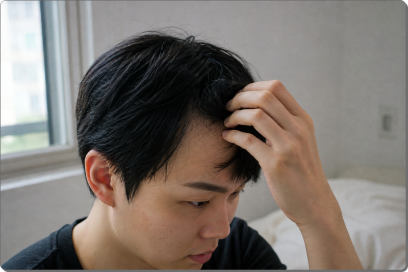 청주이마필러 앞머리 넘겼을 때 어색한 이유