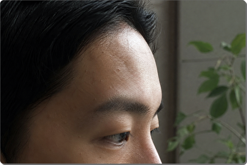 청주이마필러 앞머리 넘겼을 때 어색한 이유