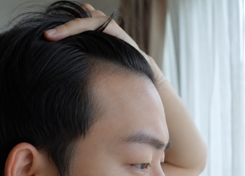 이마필러1cc 2cc 양 부작용 붓기 가격 총정리<의사답변>