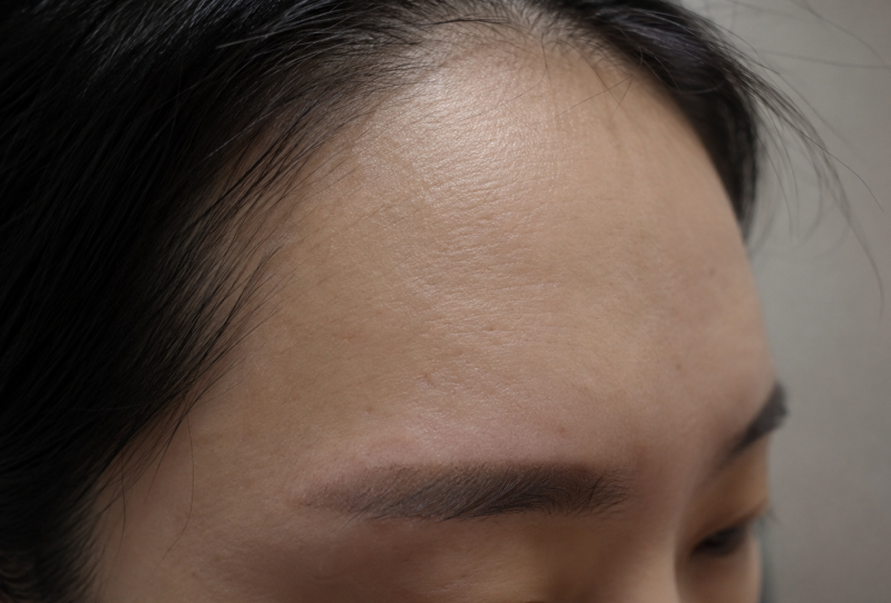 이마필러 부작용 [멍, 울퉁불퉁, 여드름, 염증, 가려움] 피하려면?