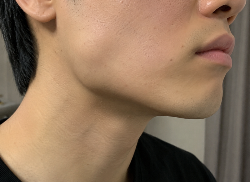 남자사각턱보톡스 용량 많을수록 효과도 크다?