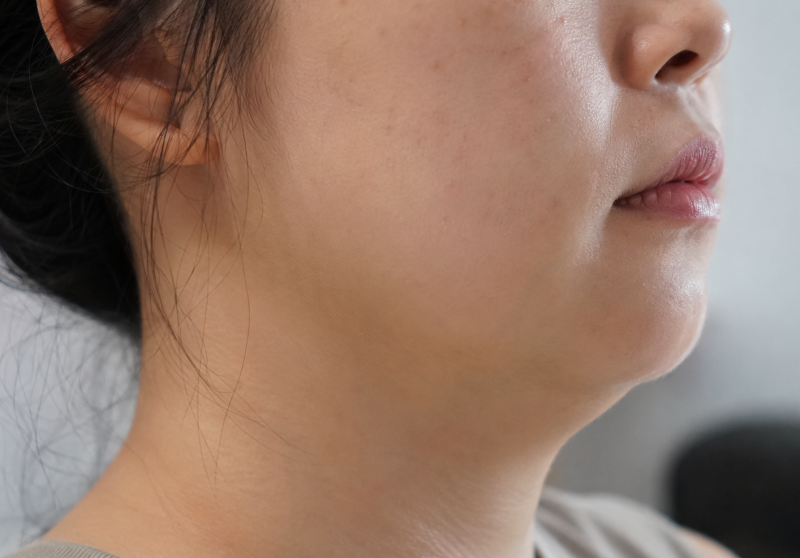 청주울쎄라 30대 효과 있을까?