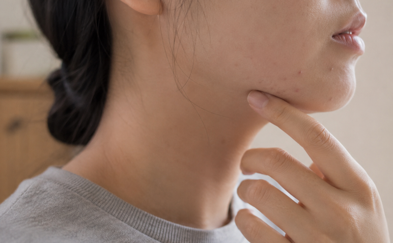 턱 모낭염 원인 증상, 피부과는 어떤 치료를 할까?