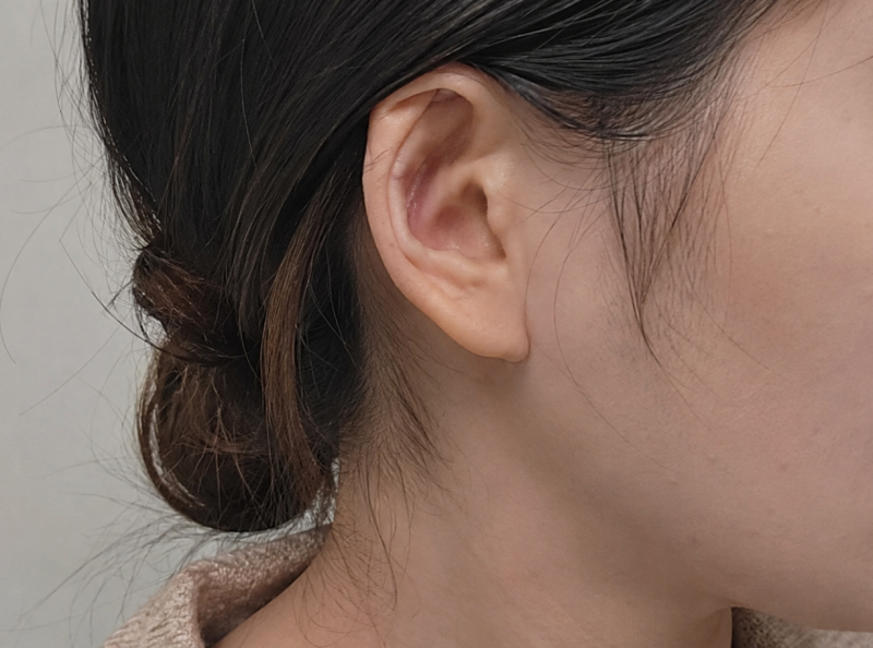 청주필러잘하는곳 귀필러, 자연스럽게 보이는 기준
