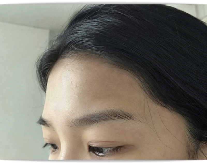 청주이마필러 하나하나 알아보세요<참고>