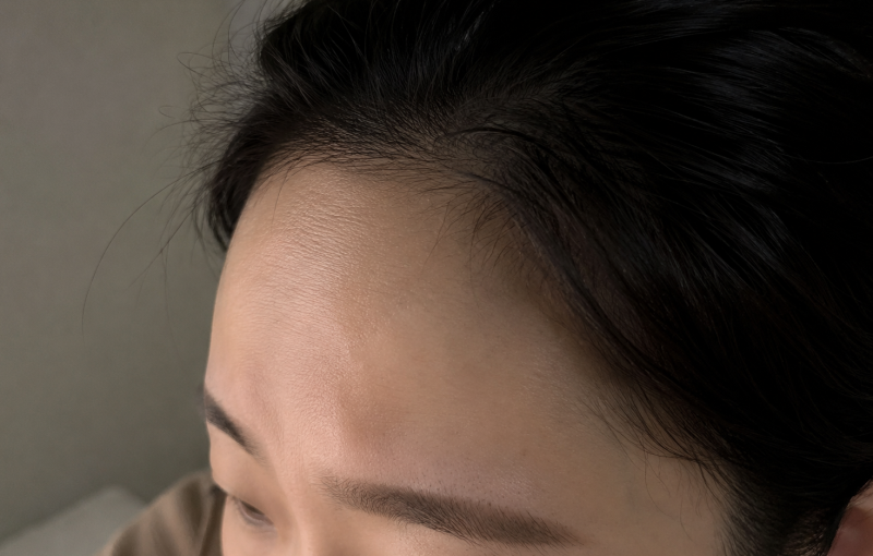 청주이마필러 하나하나 알아보세요<참고>
