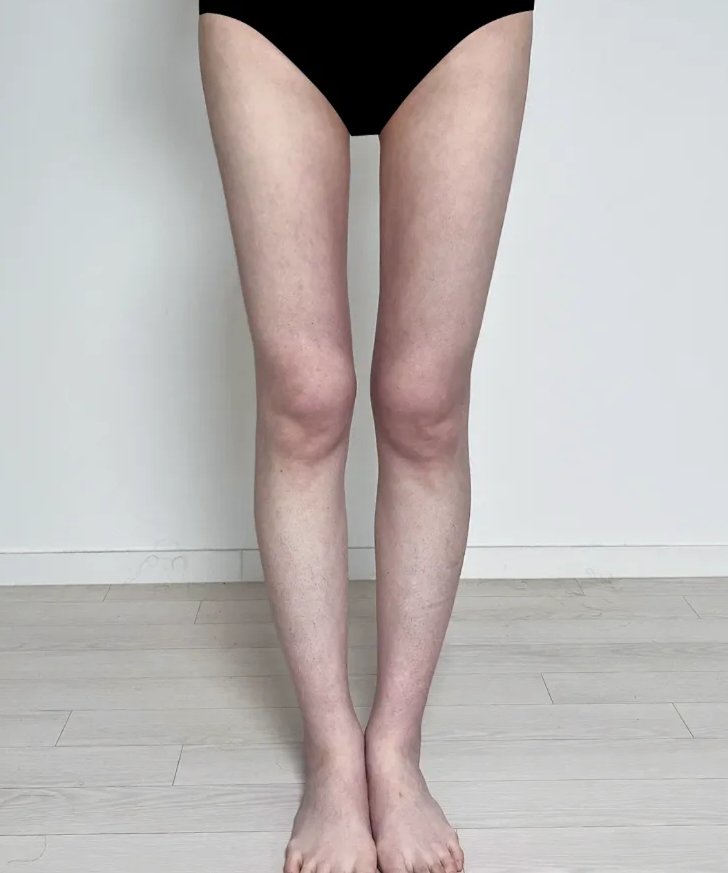 다리지방흡입 부작용, 멍보다 요철?