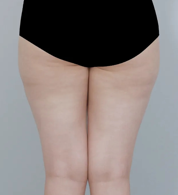 허벅지안쪽지방흡입 얼마나 가능할까?