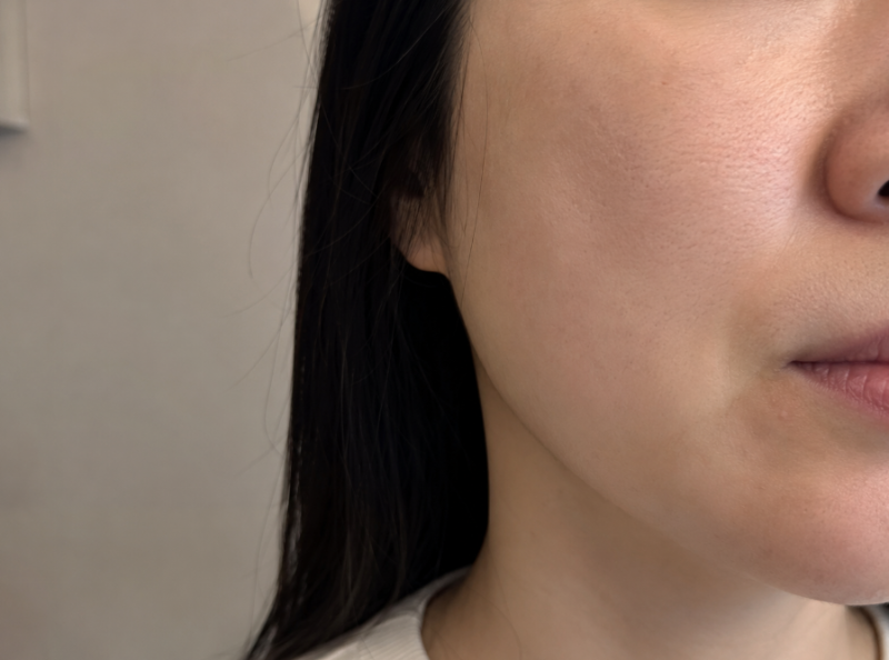 수원볼륨필러, 몇 cc보다 먼저 볼 것