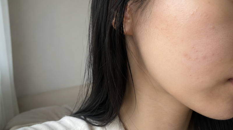 천안온다리프팅 잘하는곳? 빠른 효과보다 중요한 기준