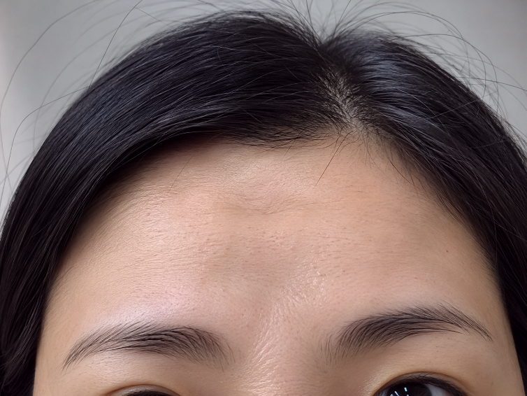보톡스필러차이, 효과·유지기간·부작용 어떻게 다를까요?