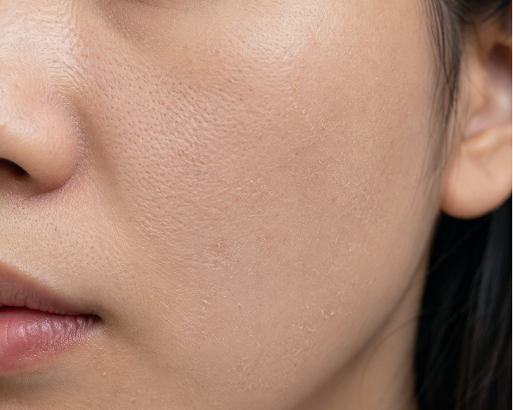 보톡스필러차이, 효과·유지기간·부작용 어떻게 다를까요?