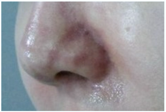보톡스필러차이, 효과·유지기간·부작용 어떻게 다를까요?