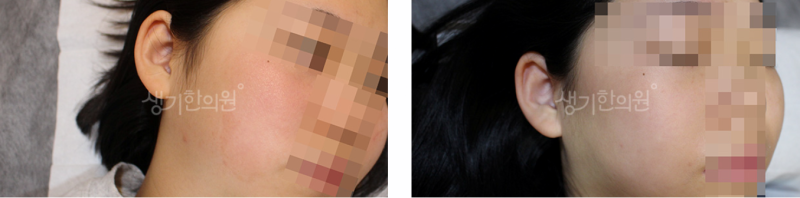 관저동피부과 지루성피부염 걱정이라면
