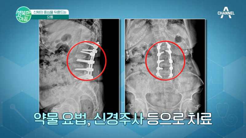 의정부정형외과 허리디스크 초기에 발견해야