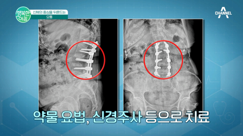 옥정정형외과 허리디스크 원인 특징 치료방향