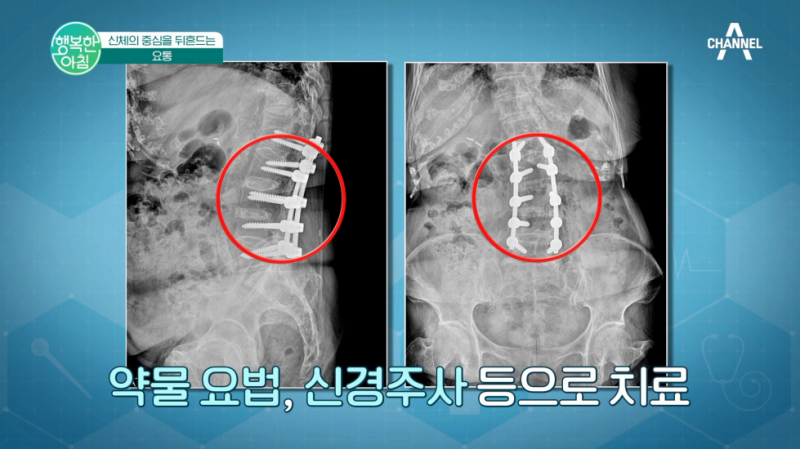 양주 옥정 정형외과 척추협착증 주요 증상과 치료 방법