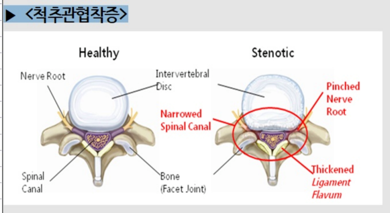 의정부정형외과 디스크와 척추협착증의 증상과 차이점
