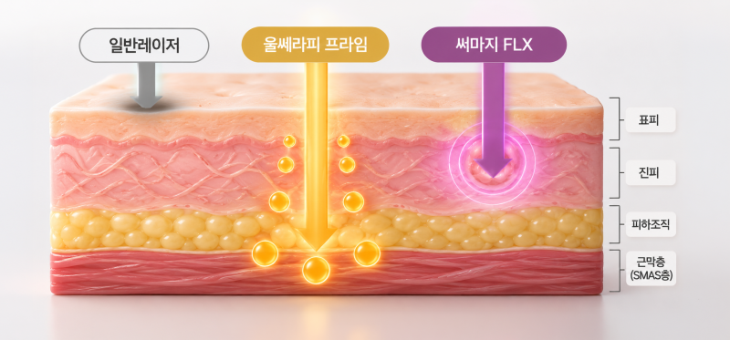 울쎄라와 써마지의 에너지 전달을 비교한 원문의 AI 참고 도식