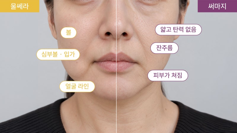 울쎄라와 써마지에서 살펴보는 얼굴 고민을 비교한 AI 예시 이미지