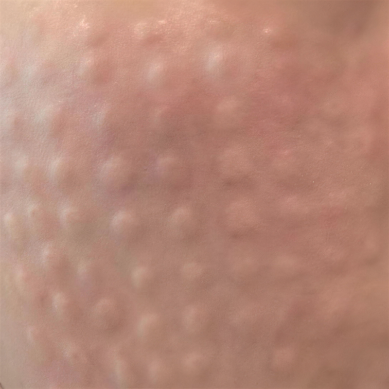 웨딩 일정 원문에서 엠보현상을 설명하는 참고 이미지