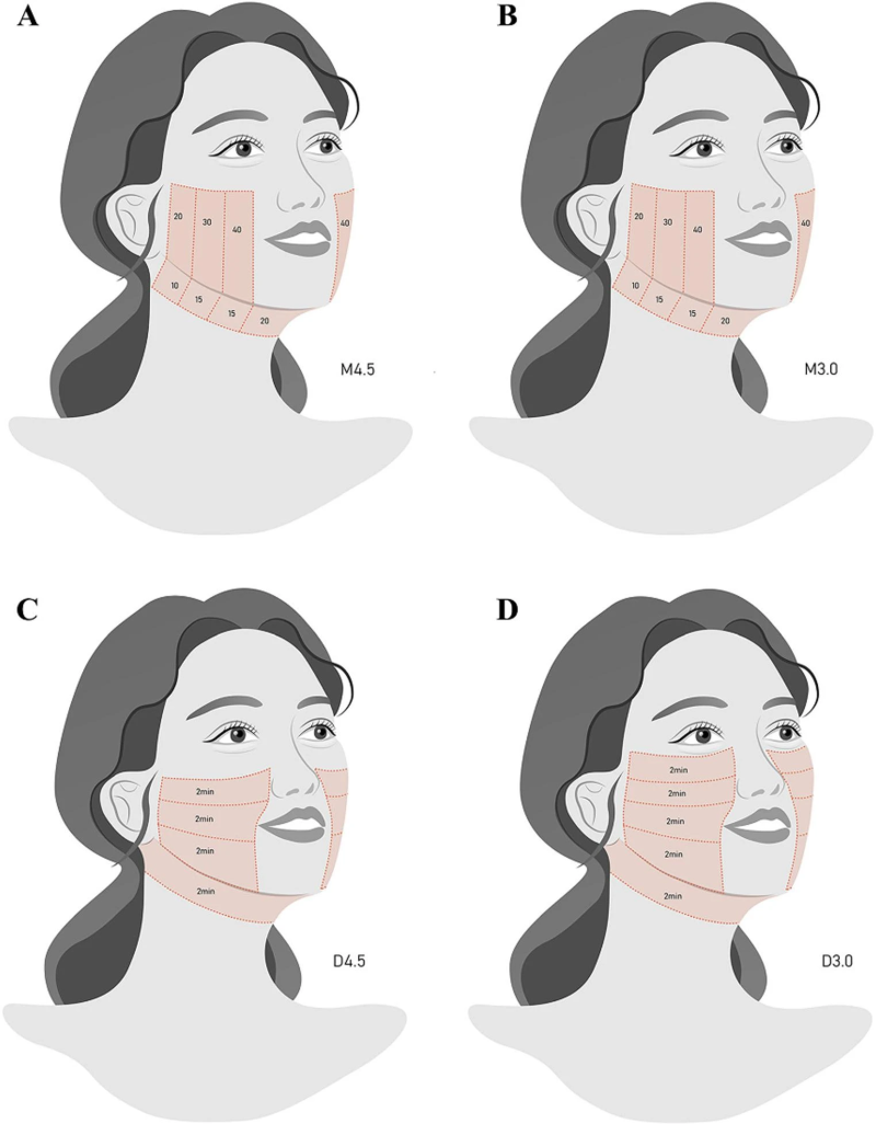 대구슈링크가격, 비용은 어느 정도이고 몇 샷이 필요할까요?