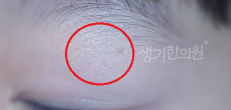 눈 주변 근처 편평사마귀 제거 먼저 짚어봐야할 점