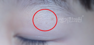 눈 주변 근처 편평사마귀 제거 먼저 짚어봐야할 점