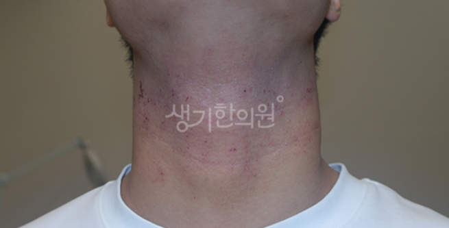얼굴 홍조 가려움 아토피 때문일까?