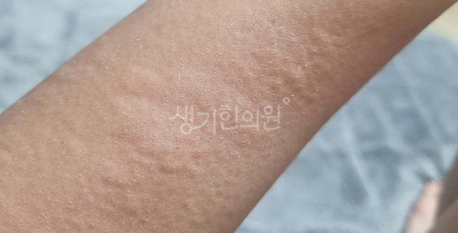 부산두드러기 병원 치료 끝까지 포기하지 마세요