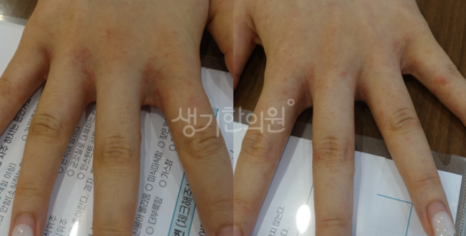 구미피부과증상 한포진 호전과 악화 반복된다면