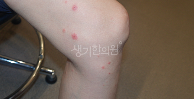 양산습진한의원 치료 후 재발까지 막아야