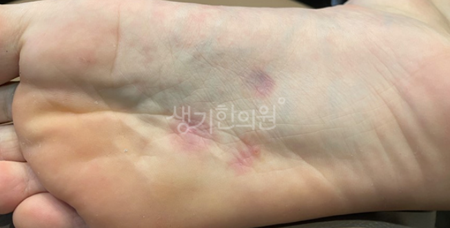 증평사마귀 봄철에 특히 잘생긴다?